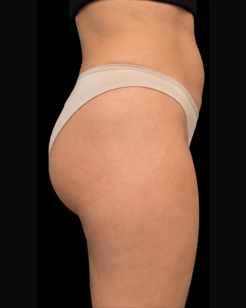 After the BAQ Method, glutes