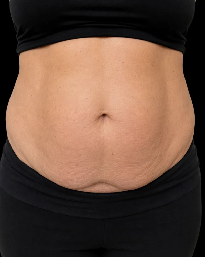 Before body sculpting, abdomen