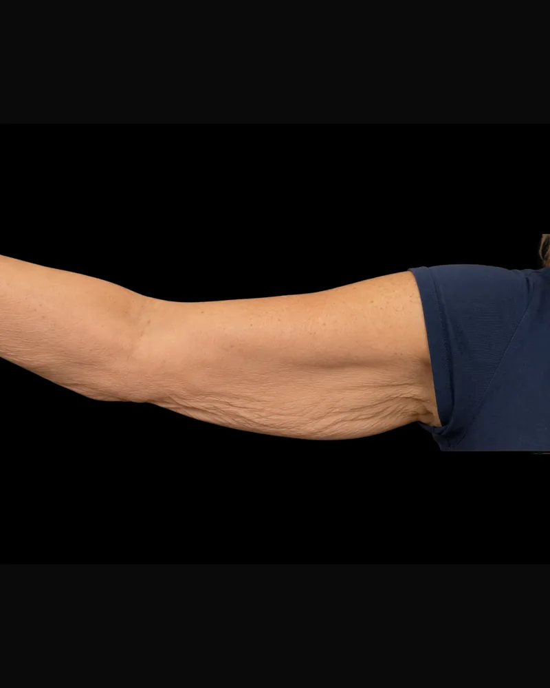 Before body sculpting, arms