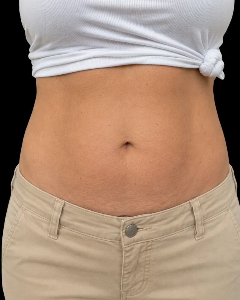 After the BAQ Method, abdomen