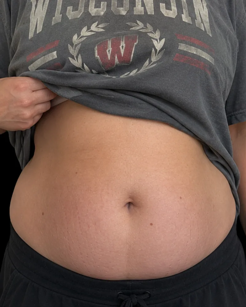 Before body sculpting, abdomen